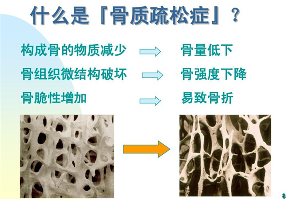 骨質(zhì)疏松怎么治療?有哪些行為有害骨健康